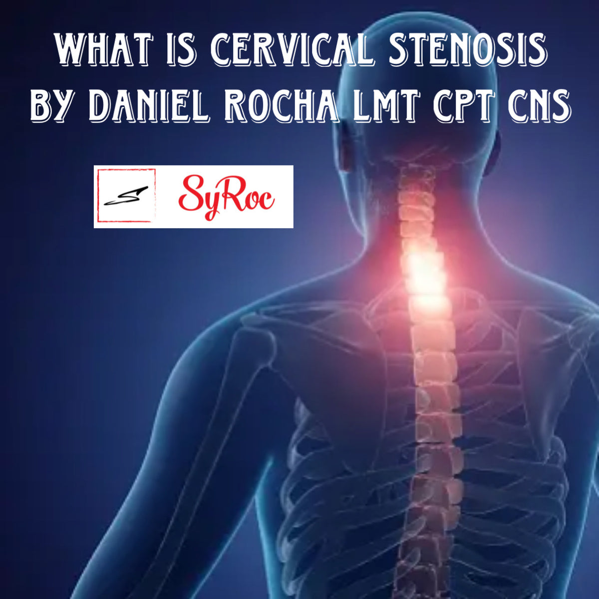 What Is Cervical Stenosis Syroc Lifestyle 5858